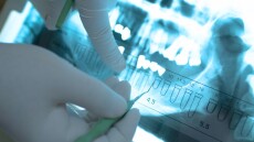 Νανο-εμφυτεύματα αποκαθιστούν την κίνηση