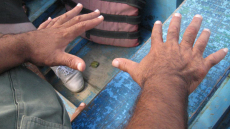 Εξαδάκτυλοι: Πώς λειτουργεί ο εγκέφαλος των ανθρώπων με ένα επιπλέον δάκτυλο σε κάθε χέρι