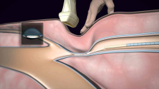 Αντιμετώπιση κιρσών με θεραπευτική κόλλα