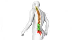 Κύστη κόκκυγος: Υπάρχει ριζική θεραπεία για την κατάσταση που μας τρομάζει