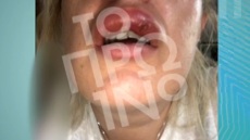 38χρονη γυναίκα καταγγέλλει γνωστό πλαστικό χειρουργό για παραμόρφωση προσώπου