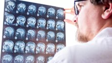 Πολλαπλή Σκλήρυνση: Νέο φάρμακο μπορεί να καθυστερήσει τα πρώιμα συμπτώματα της νόσου