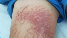 Κόρινθος: Στο νοσοκομείο 9χρονος, τον τσίμπησε θαλάσσια ανεμώνη - Δείτε φωτογραφία