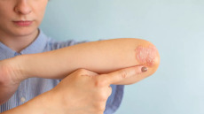 Η δερματοπάθεια που δεν κάνει διακρίσεις – Ο ρόλος του στρες