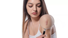 Απαλύνετε τις ενοχλητικές ουλές – Νιώστε καλύτερα με το δέρμα σας