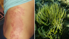 Ναύπλιο: Θαλάσσιες ανεμώνες «επιτέθηκαν» σε παιδιά σε παραλία - Τι συμβαίνει μετά το τσίμπημα