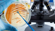 Πρόεδρος ΕΟΔΥ: Περιμένουμε περισσότερα εισαγόμενα κρούσματα mpox – Τι λέει με τον στρεπτόκοκκο