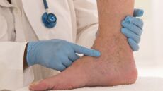 Παγκόσμια Ημέρα Θρόμβωσης: Η θρόμβωση προλαμβάνεται και θεραπεύεται