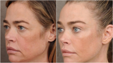 Ντενίζ Ρίτσαρντς: Φωτογραφίες με το πρόσωπό της πριν και μετά το λίφτινγκ