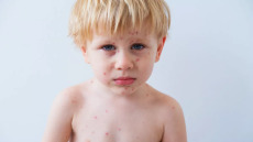 Ιός κοξάκι και άλλες μεταδοτικές ασθένειες: Πότε «επιτρέπεται» να πάει σχολείο το παιδί; Ο παιδίατρος απαντά στους γονείς