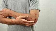 Ιός mpox: Στην τριάδα των ευρωπαϊκών χωρών με τα περισσότερα κρούσματα η Ελλάδα