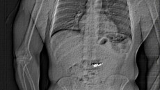 Κλέφτης κατάπιε σκουλαρίκα 750.000 δολαρίων λίγο πριν συλληφθεί