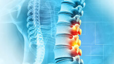 Τι είναι η αγκυλοποιητική σπονδυλοαρθρίτιδα: Ποια είναι τα συμπτώματα και ποια νοσήματα μπορεί να προκαλέσει