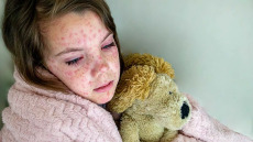 Ιλαρά: Ραγδαία αύξηση κρουσμάτων στην Ευρώπη – Τα δεδομένα στην Ελλάδα