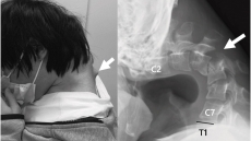 Ιαπωνία: Ένας 25χρονος στράβωσε τον αυχένα του επειδή χρησιμοποιούσε για χρόνια σκυφτός το κινητό του