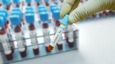 Τρεις νέες συστάσεις για την αντιμετώπιση της χοληστερίνης 