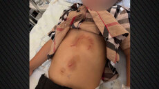 Εκδορές και δαγκώματα έχει το 5χρονο παιδί μετά την επίθεση από λύκο στη Χαλκιδική - Βίντεο δείχνει το ζώο να κυκλοφορεί ανενόχλητο στην παραλία