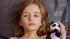 Έξαρση ιλαράς στην αμερικανική ήπειρο – Οι 3 χώρες με το 96% των κρουσμάτων
