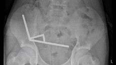 Δεκάδες μαγνήτες από τα έντερα 13χρονου αφαίρεσαν γιατροί στη Νέα Ζηλανδία
