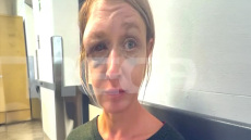 Σοκάρει η εικόνα της 40χρονης που ξυλοκοπήθηκε στο Κορωπί - «Δεν πιστεύω ότι μου επιτέθηκε ο σύντροφός μου, μπορεί οι γείτονες» λέει