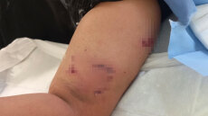 Επίθεση σκύλου σε 12χρονο έξω από σχολείο στο Πέραμα - «Ζητώ την τιμωρία του ιδιοκτήτη» λέει η μητέρα του