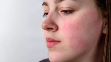 Δέρμα σε κατάσταση «συναγερμού» – Οι λύσεις που χαρίζουν ανακούφιση τον χειμώνα
