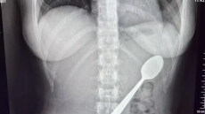 Μια 28χρονη στο Βέλγιο κατάπιε κουτάλι 17 εκατοστών όταν πήδηξε πάνω της ο σκύλος της
