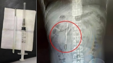 Δείτε εικόνα: Άνδρας ζούσε επί 20 χρόνια με ένα... θερμόμετρο στο σώμα του, το αφαίρεσε μετά από έντονους πόνους στο στομάχι