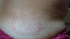 Θαλάσσια χελώνα δάγκωσε γυναίκα στο Μαράθι στα Χανιά - Δείτε φωτογραφίες