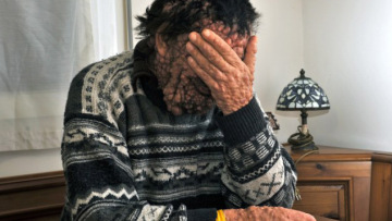 «Ο Πάπας δεν ήξερε ότι η ασθένειά μου δεν ήταν κολλητική όταν με αγκάλιασε!»