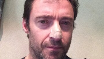 Hugh Jackman: Αποκάλυψε ότι έκανε θεραπεία για καρκίνο του δέρματος