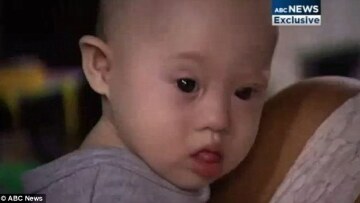 Εγκατέλειψαν το μωρό τους στην παρένθετη μητέρα γιατί γεννήθηκε με σύνδρομο Down