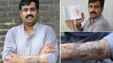 Βρετανία: Ο άντρας με το βιονικό πέος έκανε επέμβαση σμίκρυνσης