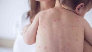 Ένα βρέφος 11 μηνών το πρώτο θύμα της ιλαράς