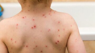 Τι απαντά ο ΕΟΔΥ (πρώην ΚΕΕΛΠΝΟ) για την ιλαρά: Σε ύφεση η επιδημία στη χώρα μας