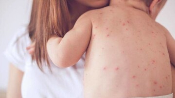 «Καλπάζει» η ιλαρά: Άλλα 100 κρούσματα την τελευταία εβδομάδα 