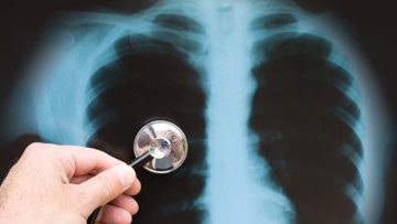 Φυματίωση: Αυξήθηκαν τα κρούσματα στην Ελλάδα το 2020