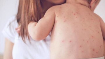 «Καλπάζει» η ιλαρά: Άλλα 103 κρούσματα την τελευταία εβδομάδα