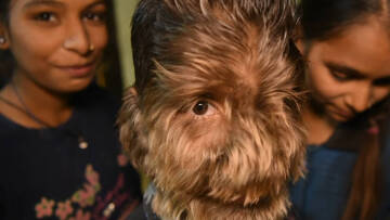 Το αγόρι-λυκάνθρωπος που θέλει να γίνει ένα παιδί σαν όλα τα άλλα