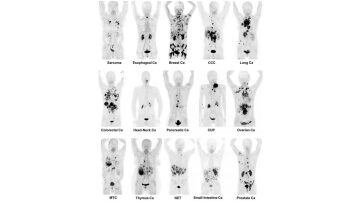 Η εξέταση που εντοπίζει 30 διαφορετικούς καρκίνους