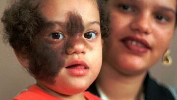 Ισπανία: 17 μωρά με το «σύνδρομο του λυκάνθρωπου» μετά από λάθος σε φάρμακο!