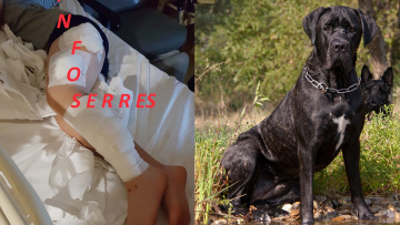 Άγρια επίθεση από σκυλιά σε 9χρονο στις Σέρρες: Δείτε φωτογραφίες με το τραυματισμένο παιδί 