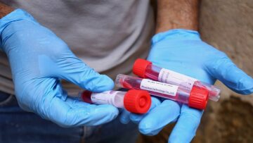 Κορωνοϊός: 45χρονος στην Ξάνθη βρέθηκε ξανά θετικός μετά από τέσσερις μήνες