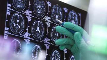 ΗΠΑ: Ο FDA έδωσε «πράσινο φως» σε νέο φάρμακο για το Αλτσχάιμερ