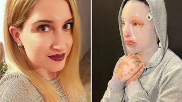  Επίθεση με βιτριόλι: Η φωτογραφία-σοκ που ανήρτησε η Ιωάννα Παλιοσπύρου