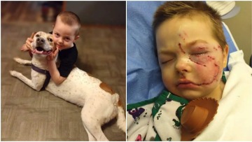 Ένα πεντάχρονο παιδί έχασε το χαμόγελό του μετά από επίθεση του σκύλου του - Προσοχή σκληρές εικόνες