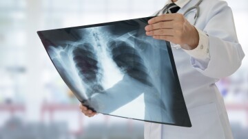 Περισσότερα μικροπλαστικά στους πνεύμονες ασθενών με καρκίνο εντόπισε ελληνική μελέτη