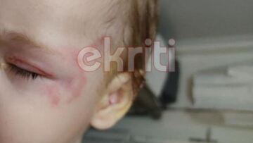 Κρήτη: Στο ΠΑΓΝΗ το βρέφος που γλίτωσε από τα δόντια του λυκόσκυλου - Δείτε φωτογραφίες