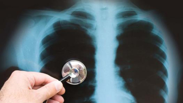 «Καμπανάκι» από τον ΠΟΥ - Η φυματίωση επιστρέφει σε όλο τον κόσμο