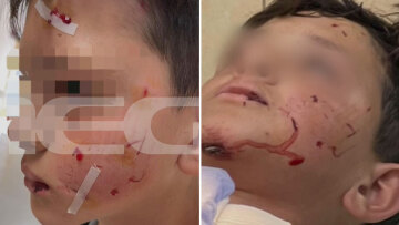 Λαγονήσι: Σκύλος επιτέθηκε σε 13χρονο